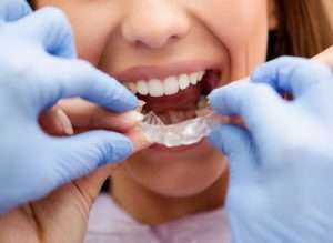 Health Benefits of Invisalign Clear Aligners