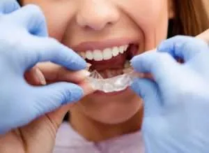 Health Benefits of Invisalign Clear Aligners