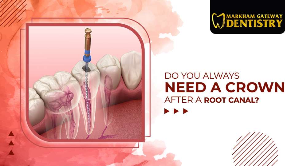 DO YOU ALWAYS NEED A DENTAL CROWN AFTER A ROOT CANAL?
