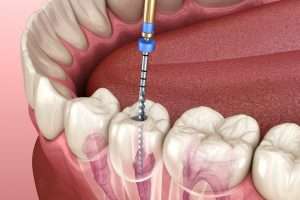 <strong>Root Canal: The Key to Saving Damaged Teeth</strong>