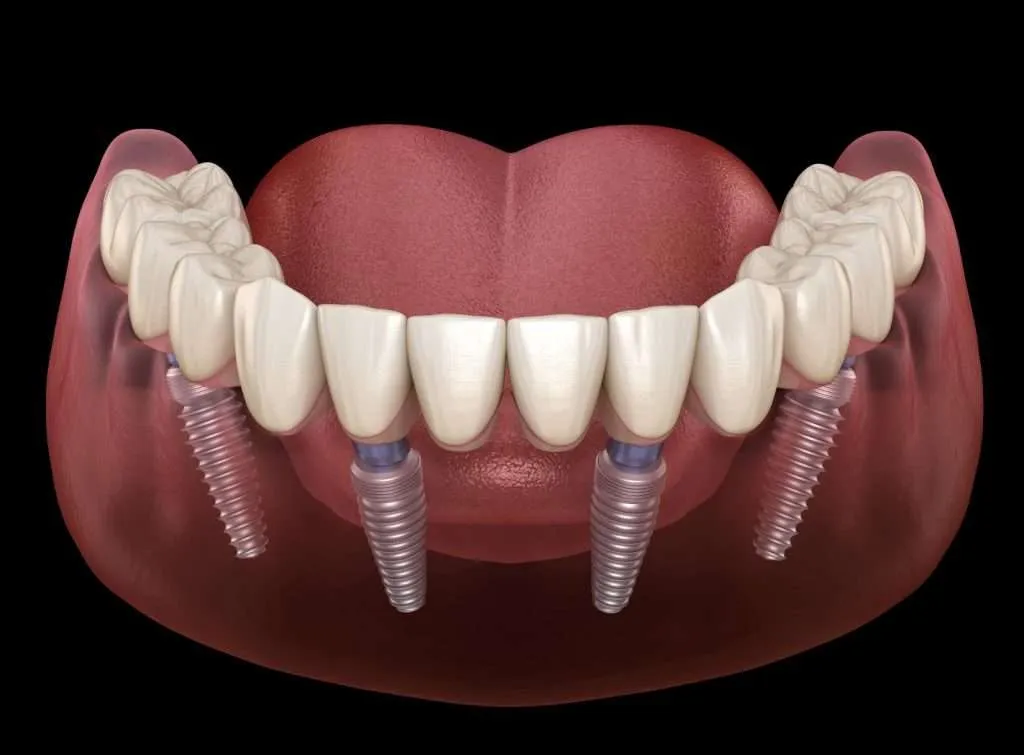 Dental Implants