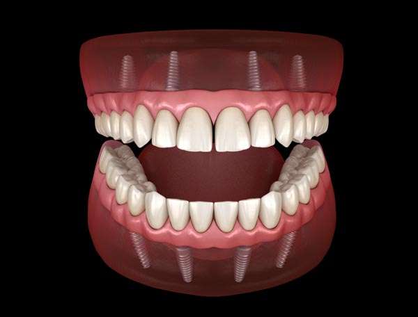 Dentures at Markham Gateway Dentistry