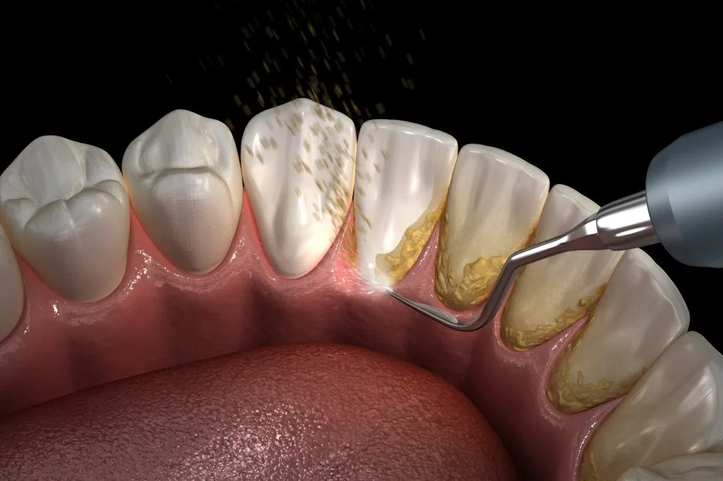 teeth cleaning