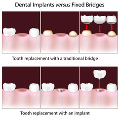 Bridges and Implants: Making the Right Choice for Your Smile