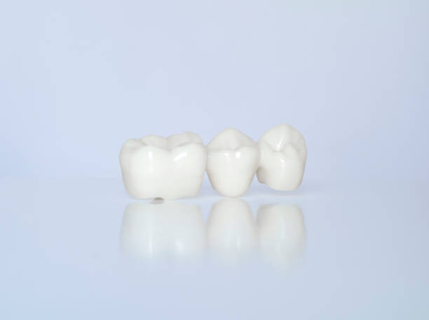 Dental_Crown