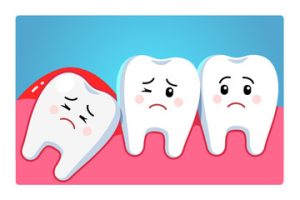 Wisdom Teeth Removal: Reasons, Process and Recovery Tips