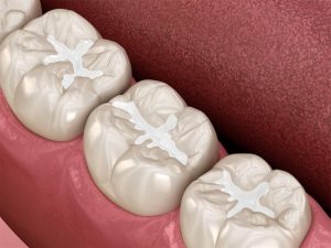 Tooth-Colored Dental Fillings: Aesthetic and Functional Solutions