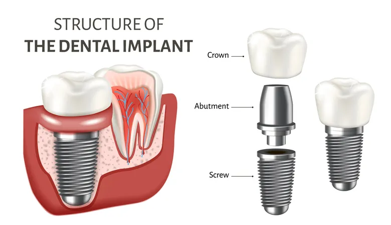 Structure of dental implants