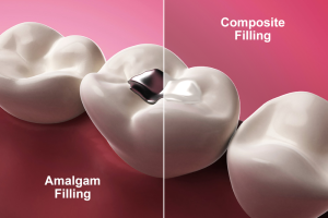 Understanding Dental Fillings: Types, Procedure, and Benefits