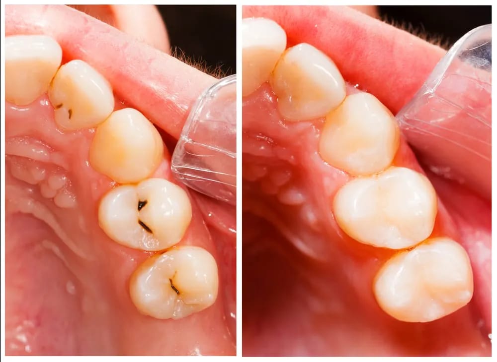 Teeth Fillings in Scarborough