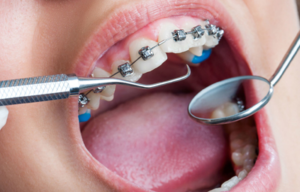 Experienced Orthodontist in Pickering: Achieving Precise Teeth Alignment