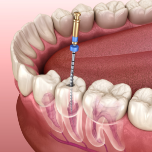 Benefits of Root Canal Treatment in Scarborough: Saving Your Natural Tooth