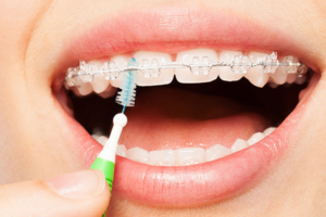 Trusted Orthodontist in Markham for Beautiful Smiles