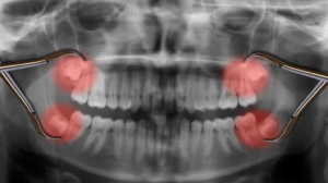 Reliable Wisdom Teeth Extraction in Scarborough: Trustworthy Expertise You Can Depend On!