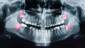The Gentle Extraction: Wisdom Teeth Removal in Markham