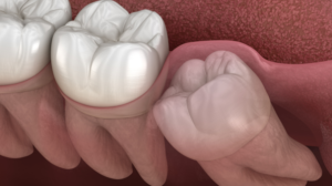 Advanced Oral Surgery for Wisdom Teeth Removal in Scarborough: Specialized Care