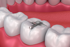 Dental Fillings in Scarborough: Understanding Their Purpose and Importance
