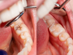5 Benefits of Tooth Fillings