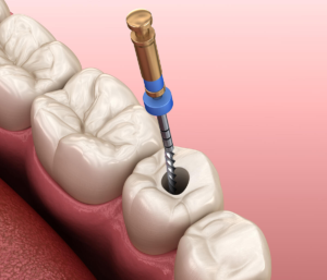 Understanding the Duration of Root Canal Recovery
