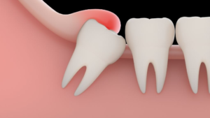 Trusted Wisdom Teeth Removal in Scarborough: Experienced Dental Surgeons