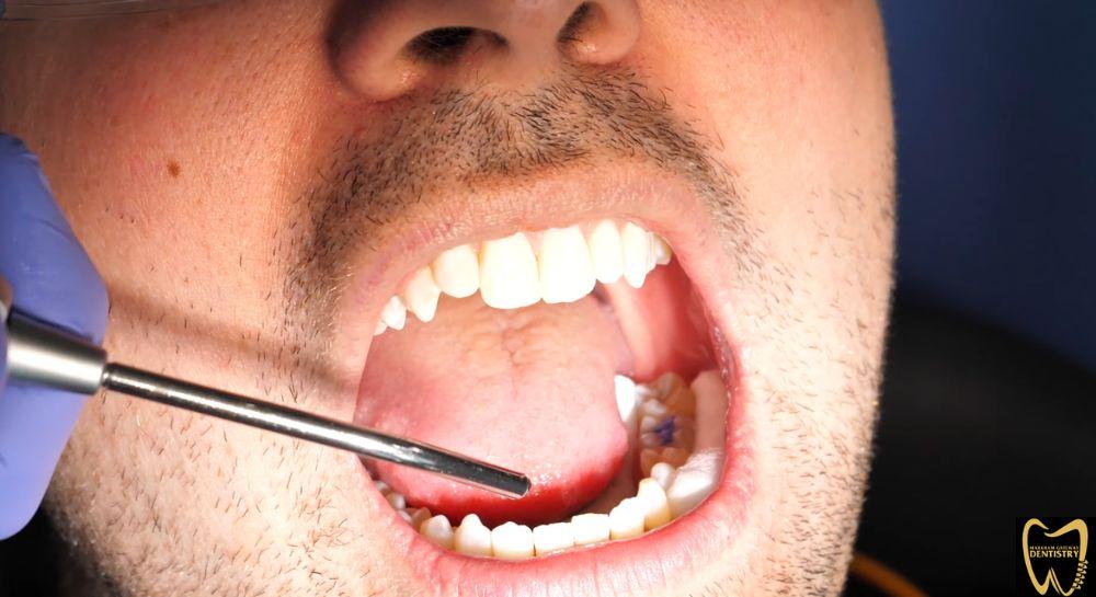 Dental Sealant Treatment in Scarborough – Markham Gateway Dentistry